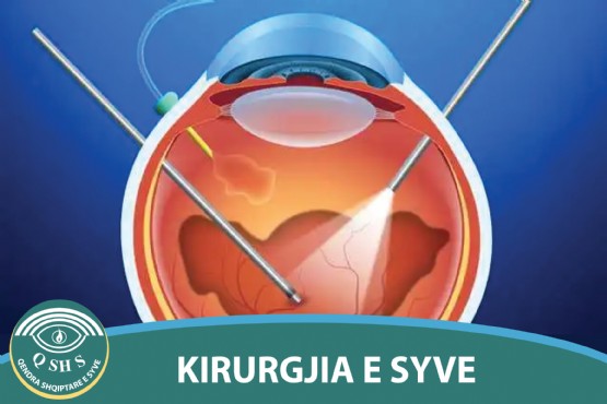 Kirurgjia e segmentit anterior, Kirurgjia e Kataraktes, Perdja e syrit, Shtremberimi i syve, Tensioni i syrit, Mish i huaj ne sy, Kirurgjie e kapakeve te syrit, entropio, ectropio, crosslinking, Mjekimi i keratokonusit, me mjek Prof Asc Ali Tonuzi